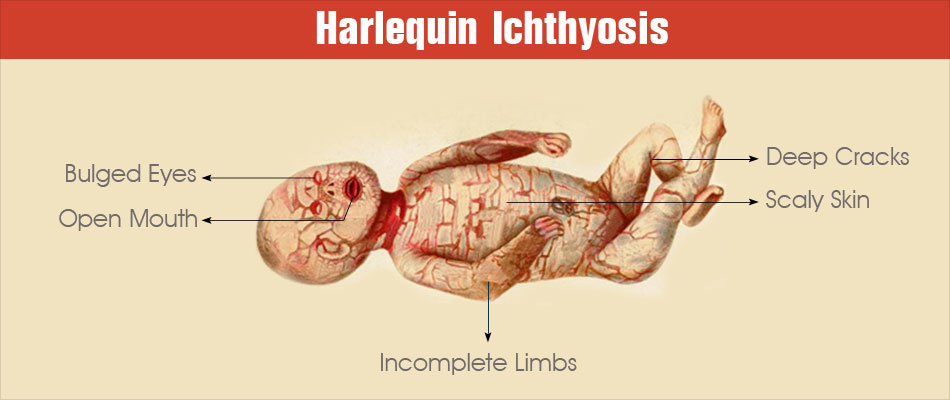 Harlequin Ichthyosis - On Both Fronts